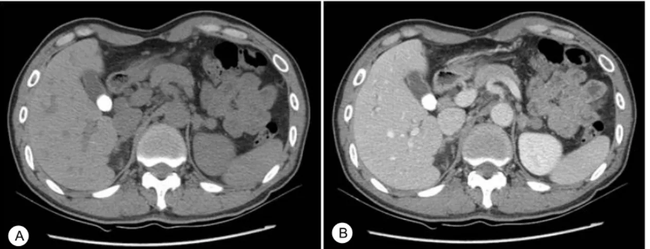Fig. 1. Dynamic adrenal gland computed tomography. Both adrenal gland show nodular hyperplasia and enlargement