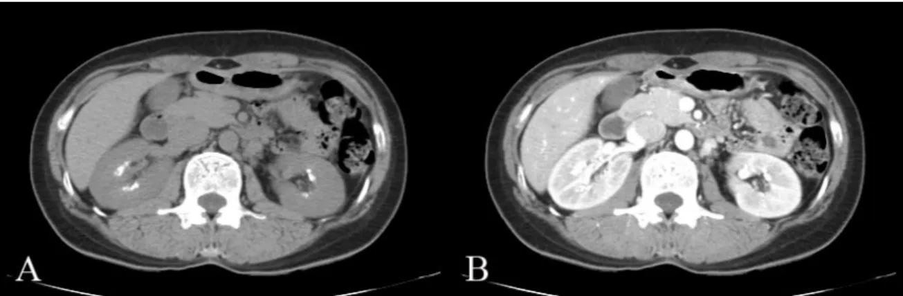 Fig. 2. Abdominal CT : Bilateral calcifications clustered in the region of the renal medulla