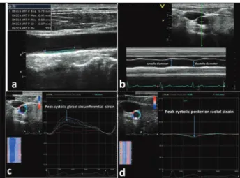 Figure 1. An automated tracking algorithm outlined the intima- intima-media complex of common carotid artery (a)