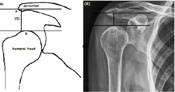 Fig 1. (A) Schematic description of shoulder subluxation. VD (vertical distance) is the distance from the most inferolateral  acromial point (a) to the most upperpoint (b) of the humeral head