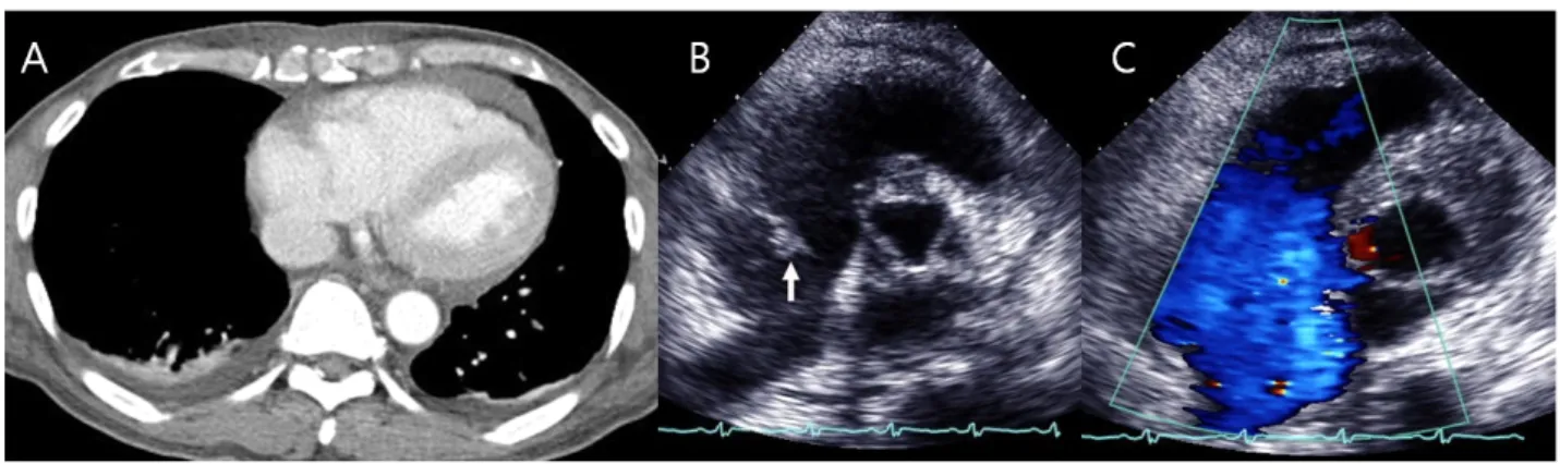 Fig. 1. Chest computed tomography scan showed small amounts of pericardial effusion anterior to the right ventricle  and  right pleural  effusion(A)