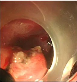 Fig. 1. Endoscopic finding. It shows a huge pedunculated  polyp  with  bleeding  arising  from  the  bulb.