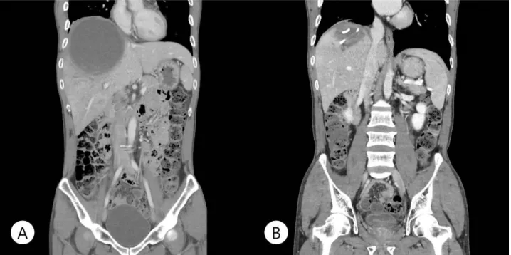 Fig. 1. (A) More than 12.3cm  sized multilayered enhanced single  lesion  in right  liver