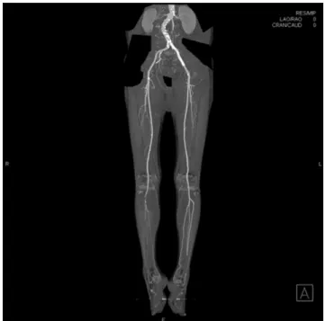 Fig.  5.  Computed  tomography  angiography  2  months  later  shows  a  well  expanded  stent  at  the  left  common  iliac  artery,  good  patency  of  the  popliteal 
