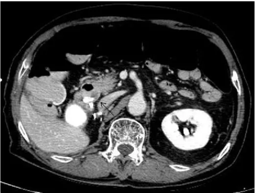 Fig.  1.  Black  arrow  in  abdomen  CT  demonstrating  9mm  sized  biliary  stone  in  the  distal  common  bile  duct.
