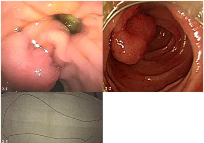 Fig.  2-2.  Endoscopy  showed  an  ampulla  of  vater  after  removing  a  remained  drawstring.