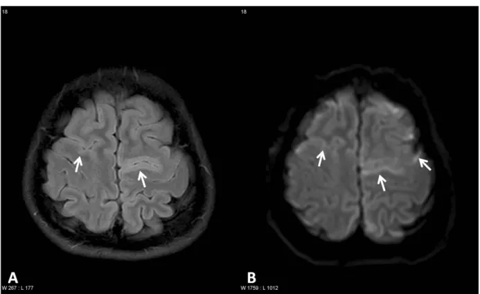 Fig. 1. Fluid-attenuated inversion recovery (FLAIR, A) and diffusion-2 weighted MR images(DWI, B) demonstrate  multiple  hyperintense  lesions  in  both  high  frontal  cortices  (arrows).