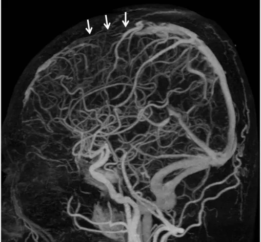 Fig. 2. Brain computed tomography (CT) angiography shows segmental 2 occlusion  of  the  superior  sagittal  sinus  due  to  thrombosis  (arrows).
