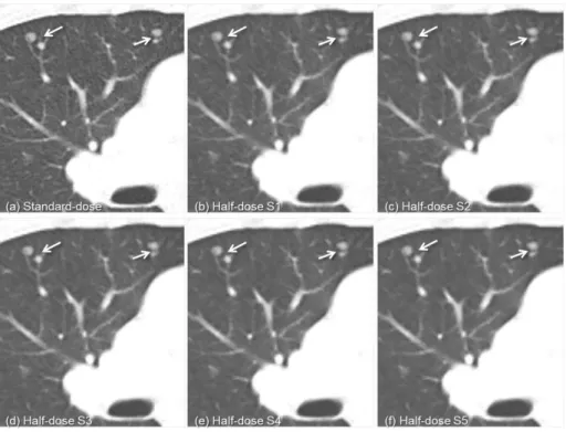 Table  2.  Scores  of  the  lesion  conspicuity  and  diagnostic  confidence  in  each  half-dose  image  reconstructed  with  different  5  strengths  of  SAFIR