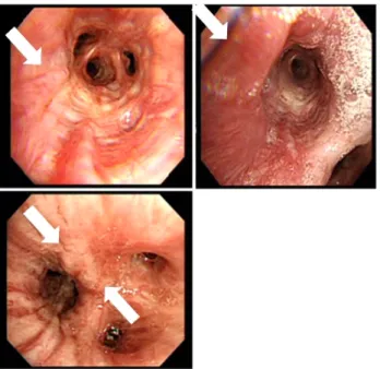 Fig. 4. Follow-up bronchoscopy after four cycles of high  dose  cyclophosphamide  showing  slightly  regressed  saccular-form  varices  in  the  right-middle  and  right-lower  bronchi,  compared  with  findings  from  the  initial  bronchoscopic  exam.