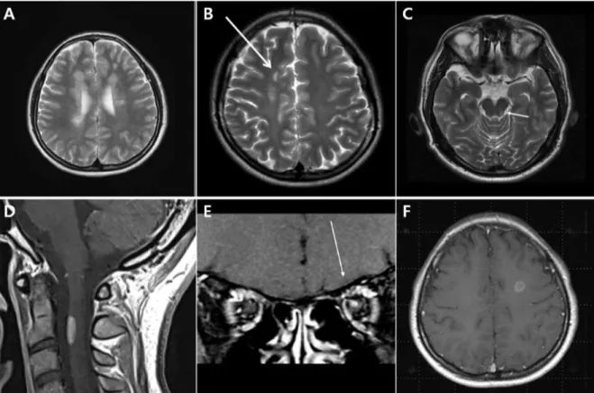 Fig.  1.  Example  of  lesion  for  multiple  sclerosis  MRI  Criteria  of  dissemination  in  space  (A)  periventricular  lesions;  (B)  juxtacortical  lesions;  (C)  infratentorial  lesions;  (D)  spinal  cord  lesion;  (E)  optic  nerve  lesion