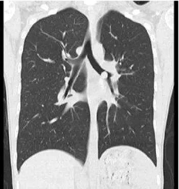 Fig.  3.  High  resolution  computed  tomography  (HRCT)  shows  an  endobronchial  nodule  in  Left  main  brohcus (1  x  1  cm).