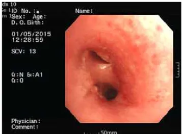 Fig.  4.  Bronchoscopy  before  surgery  shows  a  tumor  obstructed  left  main  bronchus  from  carina.