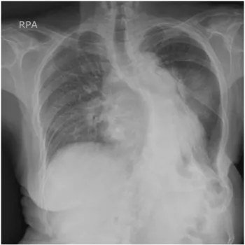 Fig. 3. Chest computed tomography. A: dilated pulmonary arteries. B: ground-glass opacities on both lung fields  and  neurogenic  tumor(black  &amp;  white  arrows)
