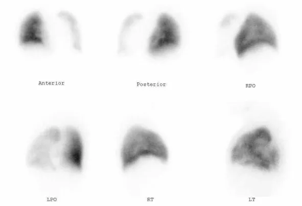 Fig. 4. Lung perfusion scan. Diffuse and severe perfusion decrease of left lung with wide photon  deficient  area  at  hilum,  probably,  due  to  effect  of  mediastinal  shaft  when  considering  chest  computed  tomography  findings.