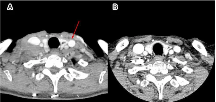 Fig.  1A.  Initial  neck  CT(Computed  Tomography)  showed  multiple  cervical  lymph  node  enlargement, 