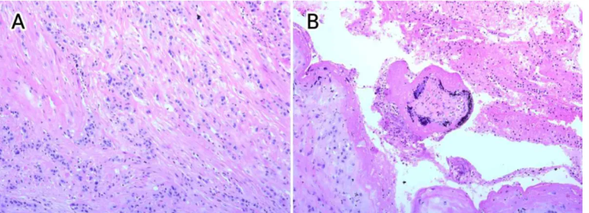 Fig.  2B.  (H&amp;E,  x  200).  In  the  perforation  site  near  serosal  side,  there  was  a  floating  well  developed  villus  admixed  with  fibrin  material