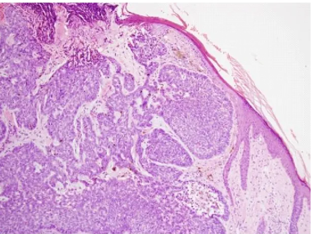 Fig.  1.  The  pathologic  findings  of  Basal  cell  carcinoma  of  skin  on  the  face