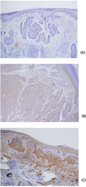 Fig.  2.  The  expression  of  VEGF  by  immunostaining  in  the  basal  cell  carcinoma  (x100) (A)  Negative  expression  of  VEGF  in  the  basal  cell  carcinoma