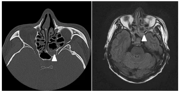 Fig. 1. Preoperative axial computed tomography (CT) and magnetic resonance images (MRI)  show  left  sphenoid  sinus  lesion.