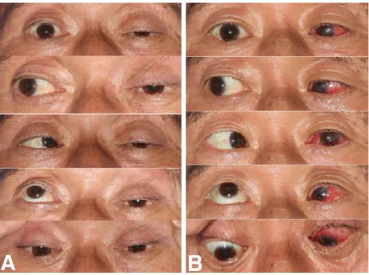 Fig.  2.  These  are  postoperative  extraocular  movements  of  the  patient.