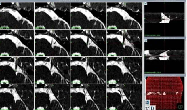 Fig. 1. Gamma Knife radiosurgery isodose distributions including the root entry zone (REZ) of the trigeminal nerve  immediately  adjacent  to  the  pons.
