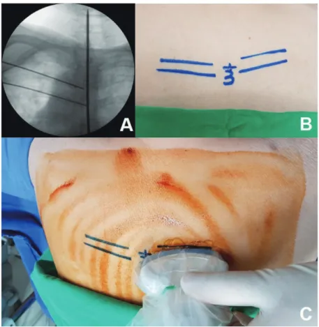 Fig. 2. (A) C-arm view showing the direction of the third and fourth ribs. (B) Skin was marked along the running direction of the third and fourth ribs