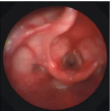 Fig. 1. Bronchoscopic view of subglottic stenosis