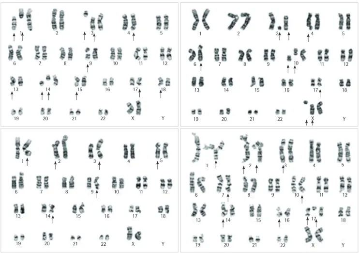 Fig. 1. G-banded karyogram 1 day after chemotherapy (cisplatin and etoposide) showing chromosomal instability, including chromatid gap (chtg)  or break (chtb), chromosomal gap (chrg) or break (chrb), and fragmentation