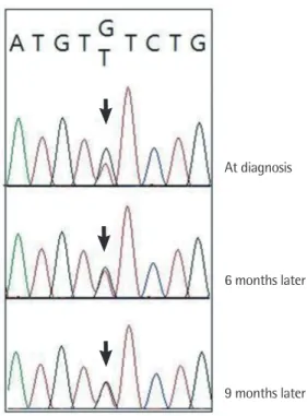Fig. 4. The chromatogram of direct sequencing for JAK2 exon 14. The  JAK2 V617F mutation is detected in serial three bone marrow  sam-ples