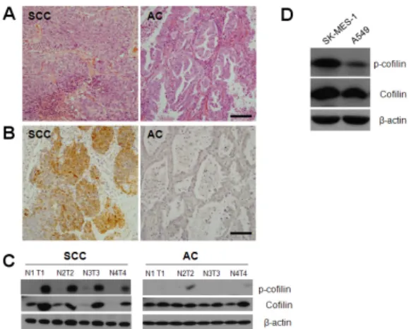Fig. 2. Expression of cofilin phosphorylation in human lung tissues  and cell lines. (A) Comparison of hematoxylin and eosin staining  from lung sections of patients with SCC and AC