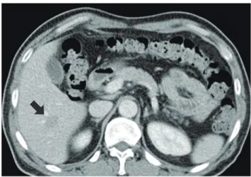 Fig. 1. Initial abdominal enhanced CT findings on the first diagnosis of  liver abscess