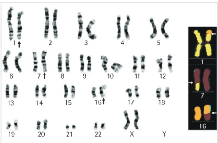 Fig. 2. Karyotype of the female patient (mother of the abortus) with  pseudocolored mFISH (on the right), showing a three-way  transloca-tion involving chromosomes 1, 7, and 16.
