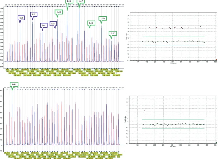 Fig. 1. Results of MLPA analysis for patient 1 (non-contiguous duplication of exons 2-7 and 45-51).
