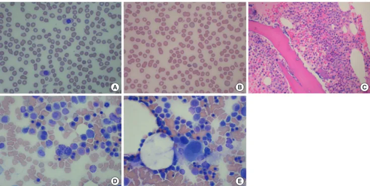 Fig. 2. G-banded karyogram of bone marrow cells. (A) A derivative chromosome composed of the short arm of chromosome 9 and the long arm of  chromosome 17