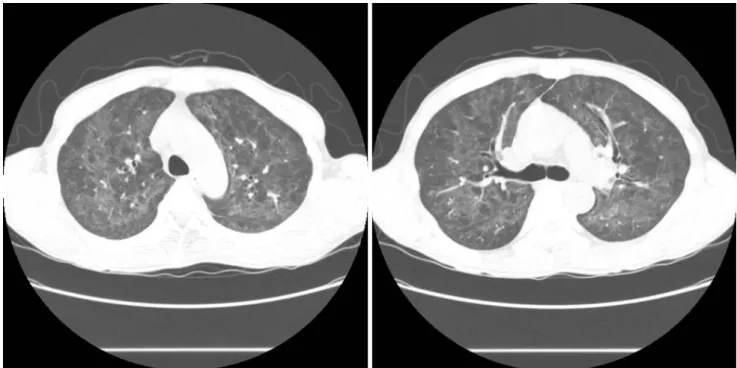 Fig. 1. Initial chest computed tomography reveals diffuse ill-defined ground glass opacities in both lungs, which indicates atypical pneumonia  caused by cytomegalovirus or Pneumocystis