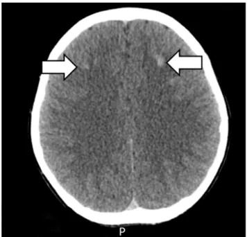 Fig. 2. The brain CT scan. Multiple high density nodular lesions in the bilateral basal ganglia 