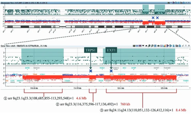 Fig. 2.  Array CGH analysis of the genome of the patient shows three interstitial deletions from 8q23.1 to 8q24.13, arr[GRCh37] 8q23.1q23.3  (108685855_113293548)x1, arr[GRCh37] 8q23.3(116375596_117136492)x1, and arr[GRCh37] 8q24.11q24.13(118051132_1264121