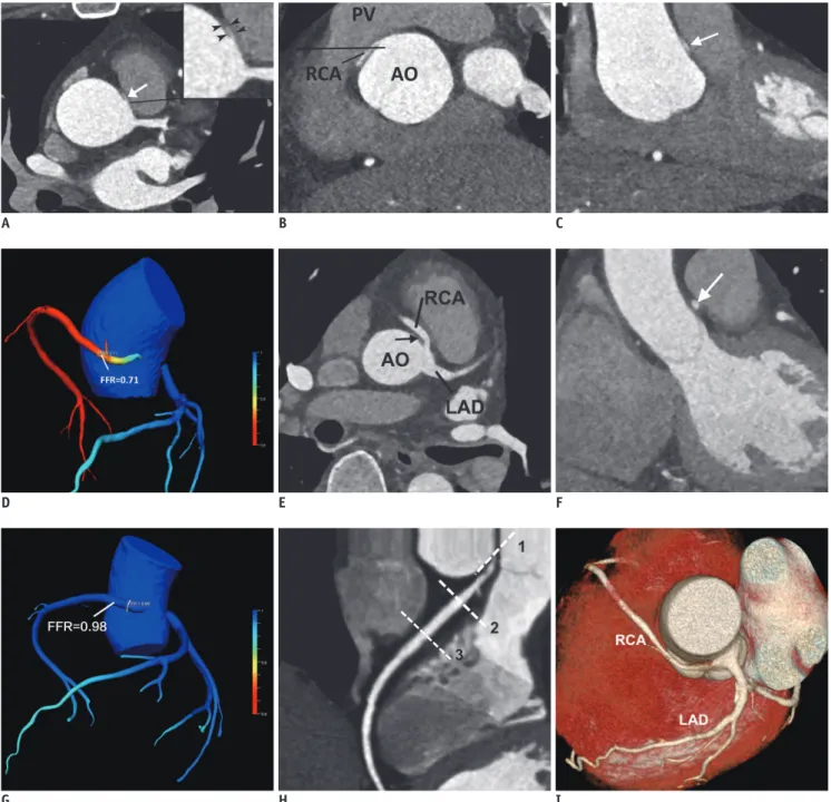 Fig. 1. Representative cases of R-ACAOS with interarterial course R-ACAOS with interarterial course in 54-year-old man presenting  with typical angina (A-D) and 49-year-old man without any complaint (E-G)