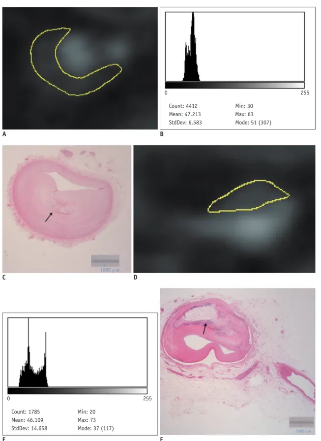 Fig. 1. Example of CT quantitative pixel density histogram analysis of lipid and fibrous plaques