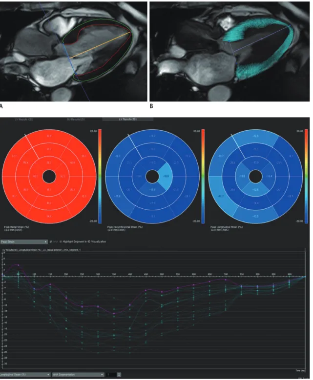 Fig. 2. Assessment of left ventricular myocardial strain using CMR feature tracking software in 72-year-old male with severe AS