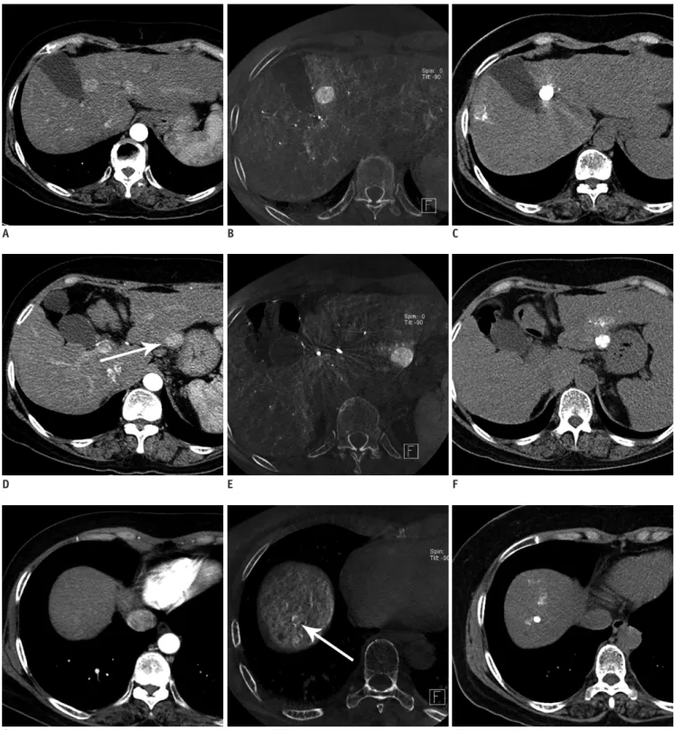 Fig. 3. 62-year-old woman with overt HCCs on initial dynamic CT and multiple hidden (additional hypervascular) foci seen on  CBCT-HA
