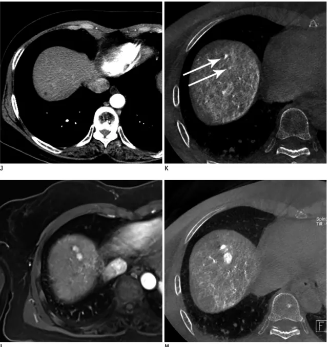 Fig. 3. 62-year-old woman with overt HCCs on initial dynamic CT and multiple hidden (additional hypervascular) foci seen on  CBCT-HA