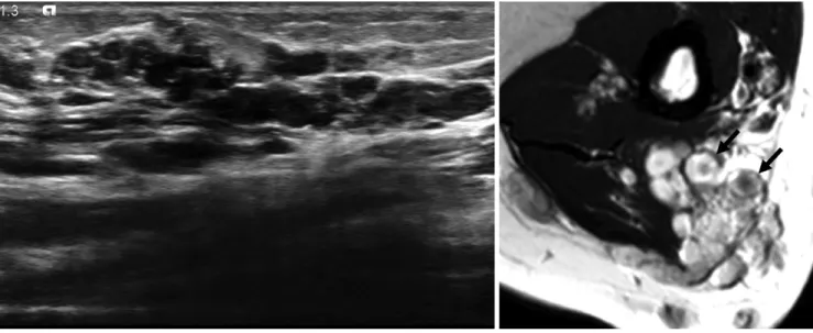 Fig. 15. Giant cell tumor of tendon sheath in 9-year-old  girl with palpable mass at finger