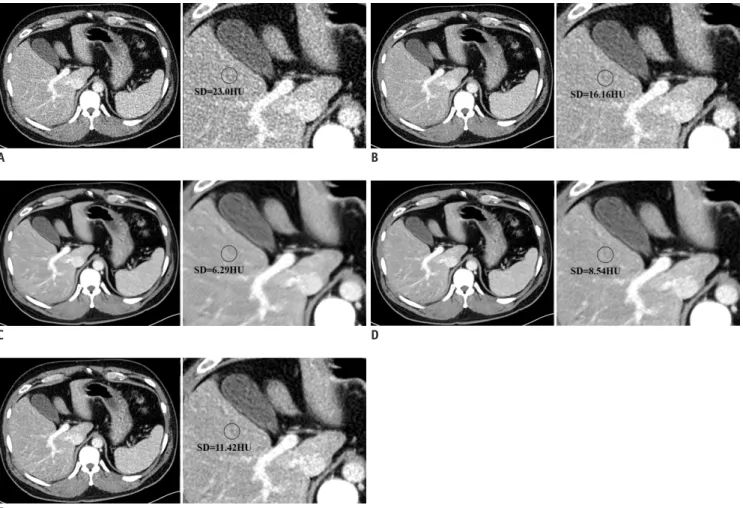 Fig. 4. LD abdominal CT images of test set with conventional reconstruction methods (A, B) and with DLA (C-E)