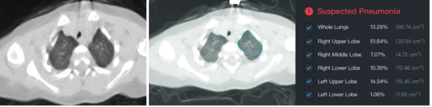 Fig. 1. Chest CT scans for 10-month-old patient in Case 1. 