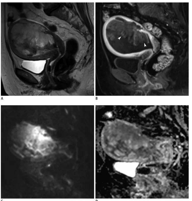 Fig. 2. MRI finding in representative case of high-grade ESS.  88-year-old female patient with 9.0-cm high-grade ESS involving both  endometrial cavity and myometrium
