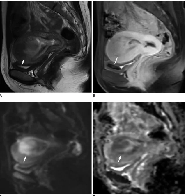 Fig. 3. MRI finding in representative case of AS.  31-year-old woman with 5.6-cm AS located within endometrial cavity (arrows), with  superficial myometrial invasion and protrusion into uterine cervix
