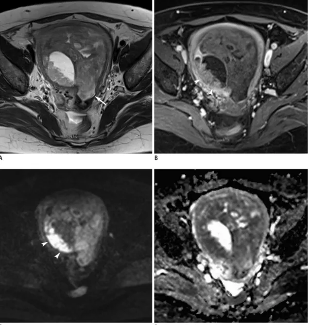 Fig. 4. MRI finding in representative case of uterine carcinosarcoma.  56-year-old woman with 10-cm carcinosarcoma causing distension  of uterine cavity.