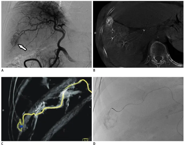 Fig. 2. Technique of HepaSphere TM  (Merit Medical) TACE.